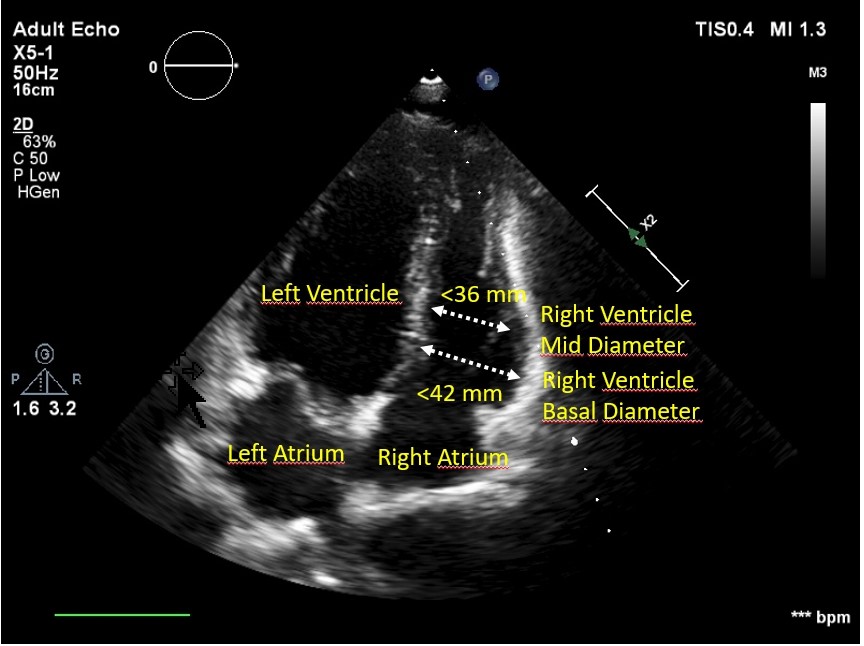 Right ventricular strain