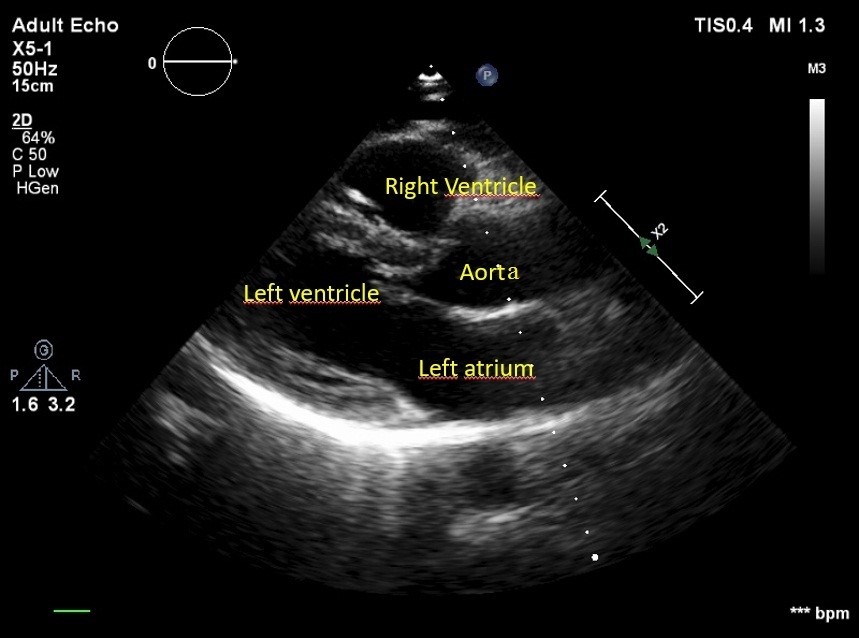 Hennepin Ultrasound  Right Ventricular Strain in Pulmonary Embolism