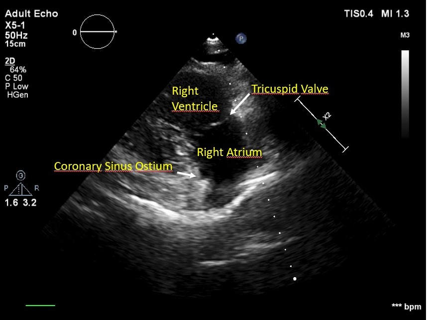 Hennepin Ultrasound  Right Ventricular Strain in Pulmonary Embolism