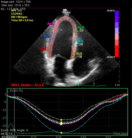 Global Longitudinal Strain by Echocardiography Predicts Long-Term