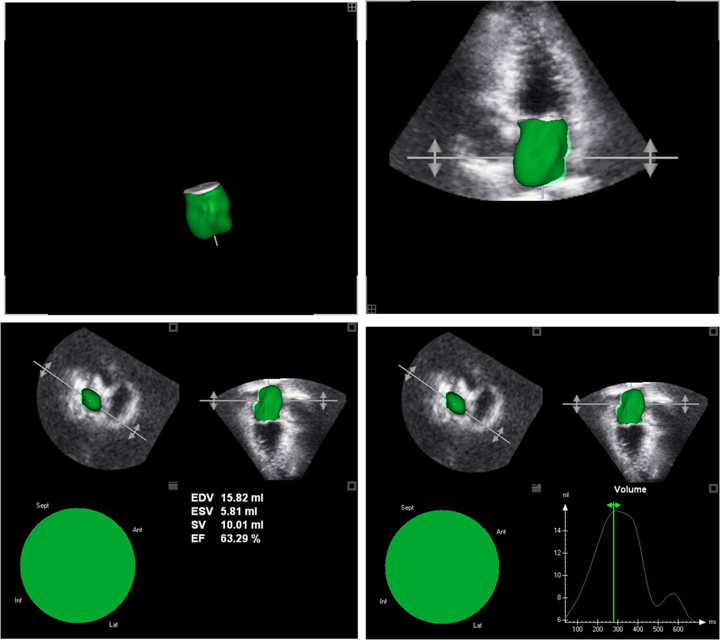 PDF] Echocardiographic reference ranges for normal left ventricular 2D  strain: results from the EACVI NORRE study